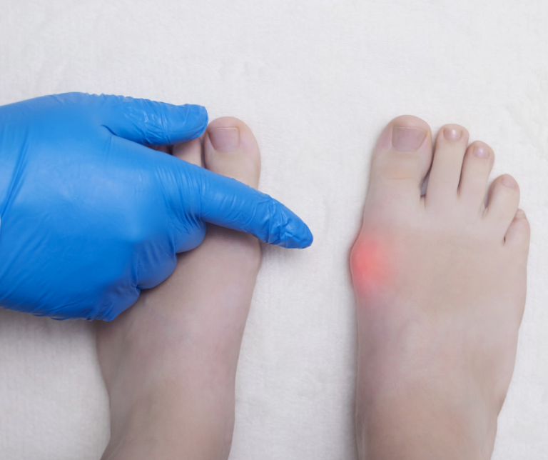 doctor pointing at large bunion on the left side of a foot near big toe