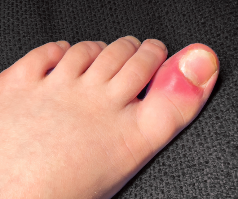 Decoding the Pain and Stiffness in Your Big Toe Joint