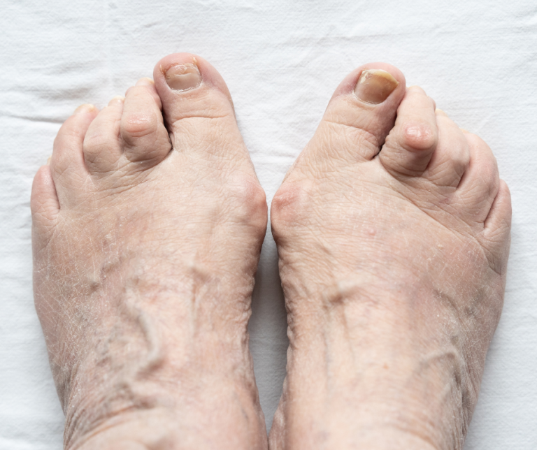 How Can I Fix My Painful Hammertoe?