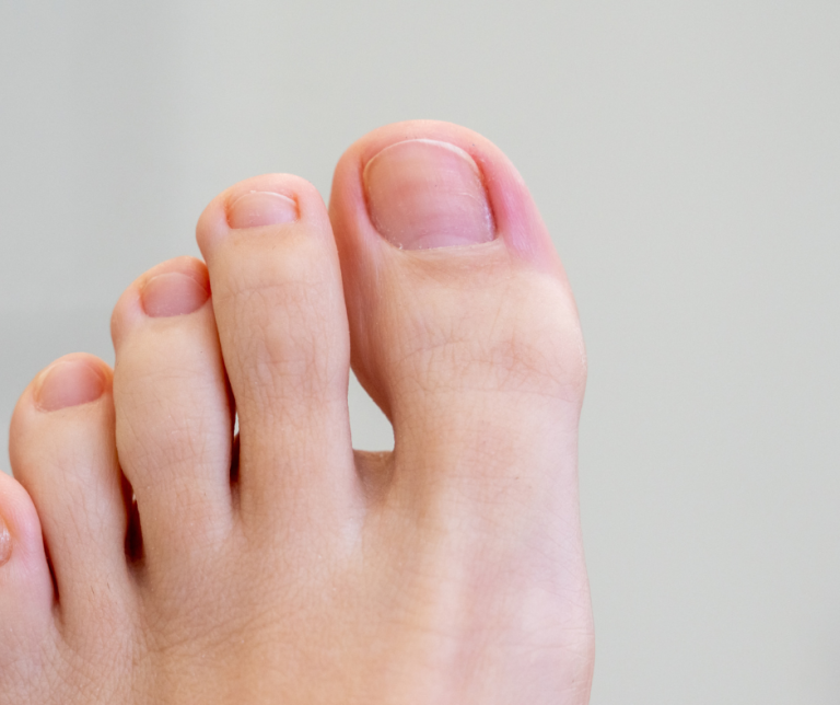 Gout in Your Big Toe? Avoid The One Holiday Food That Puts You at Risk