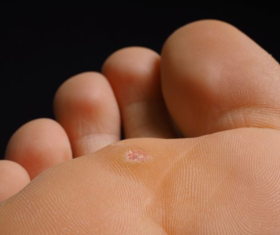 plantar wart